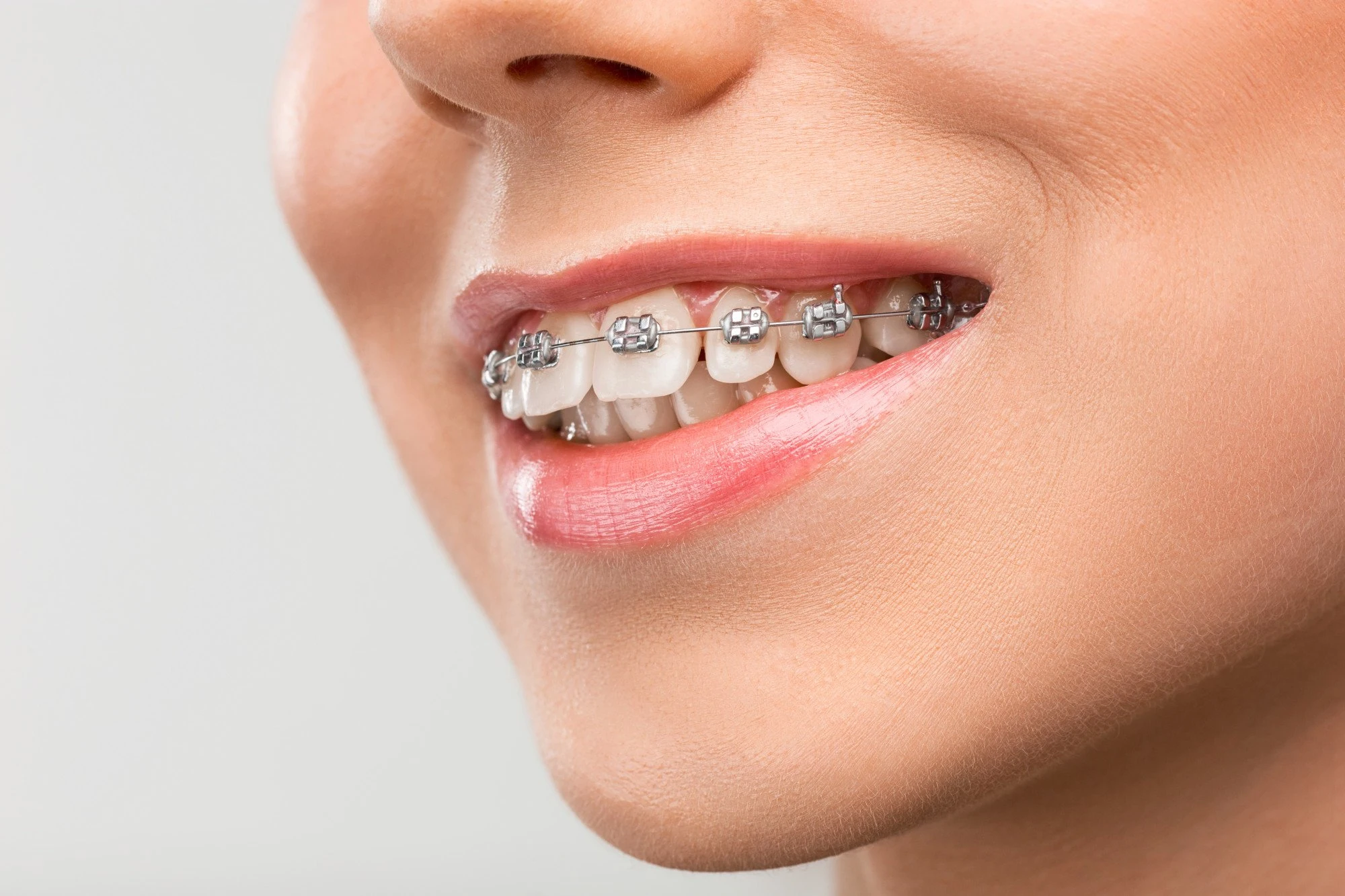 Metal braces placement