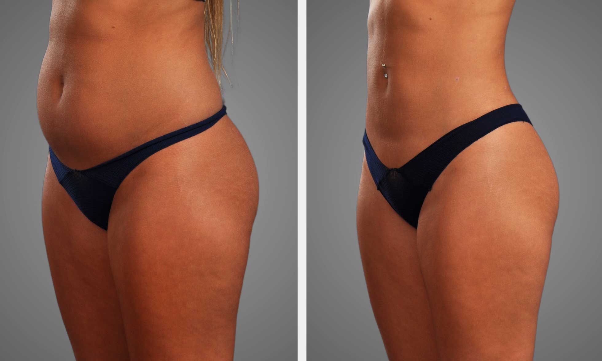 LIPOSUCTION AND FAT TRANSFER