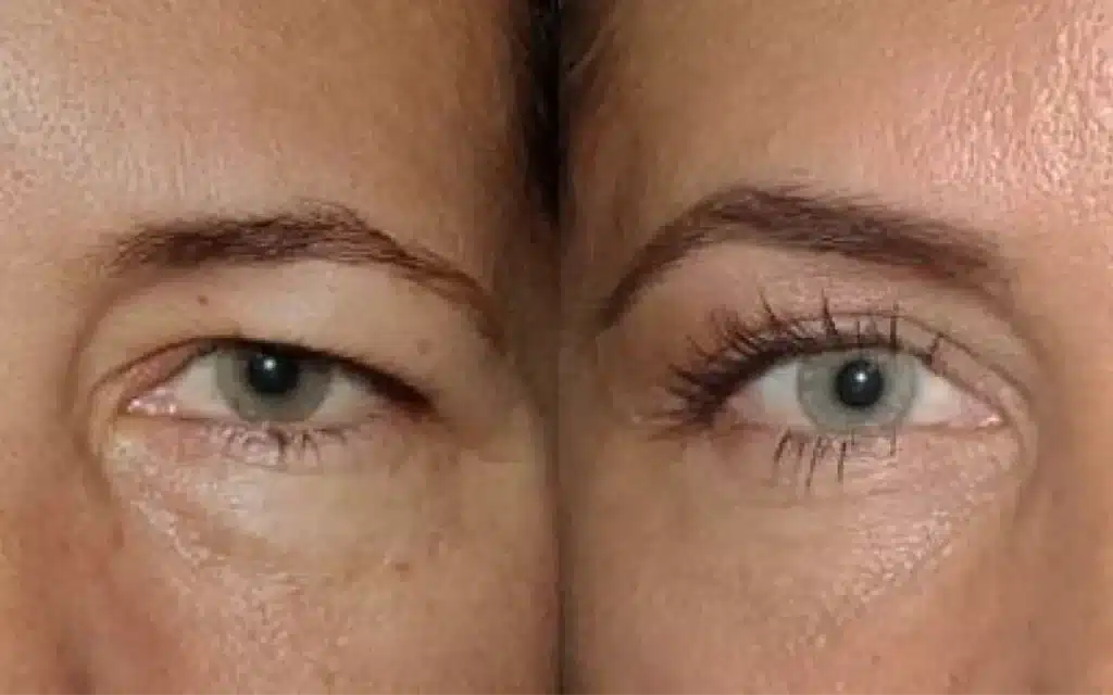 BLEPHAROPLASTY AND BROV/S LIFTING