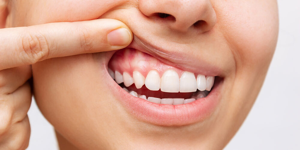 Preventive Gum Treatments