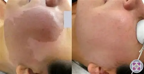 Birthmarks removal