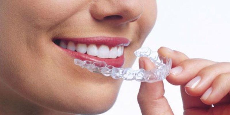 Clear aligner therapy