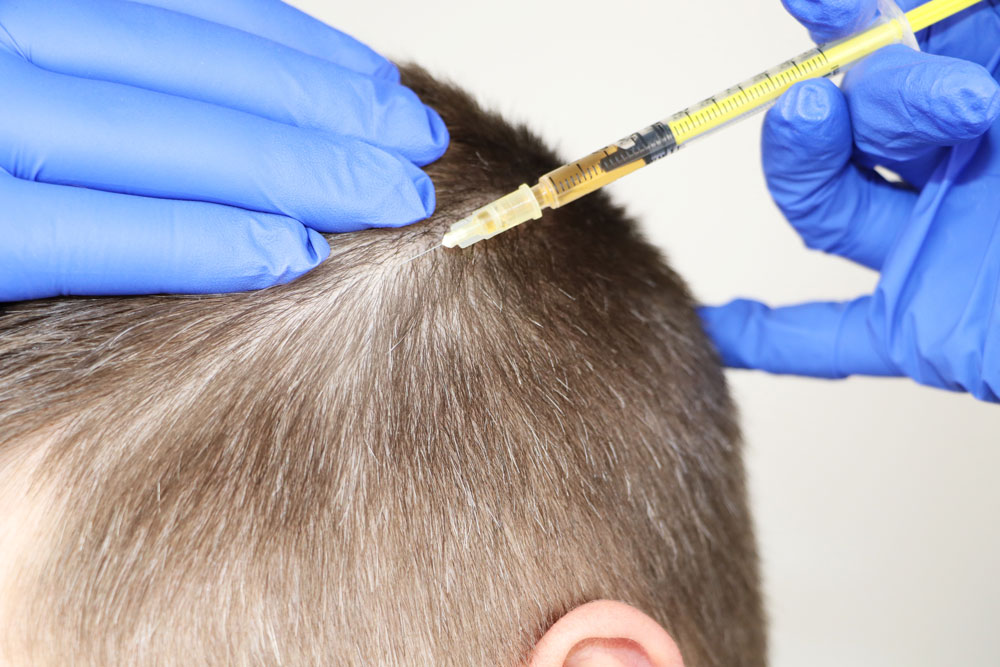 Scalp mesotherapy