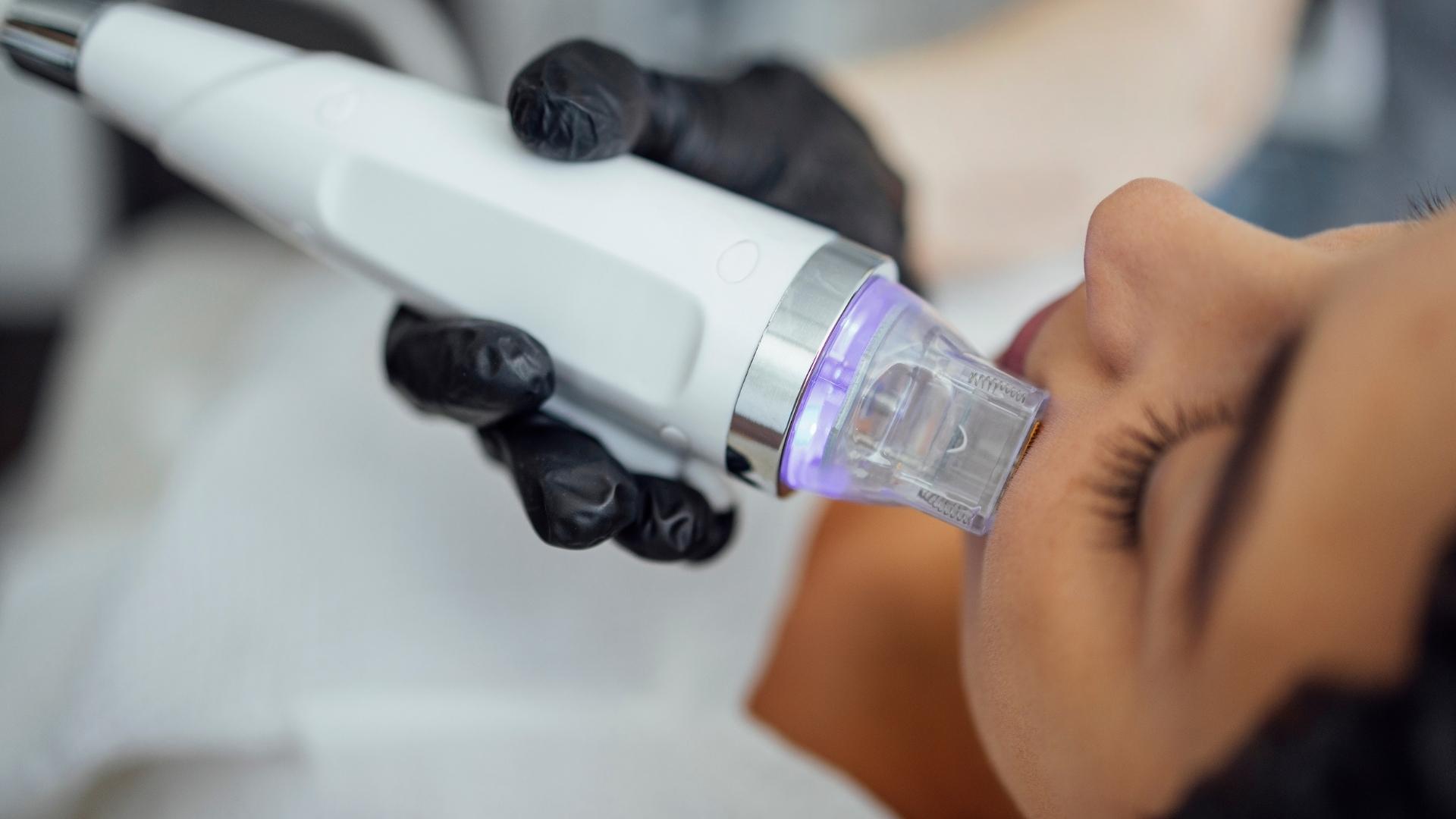 Microneedling radio frequency