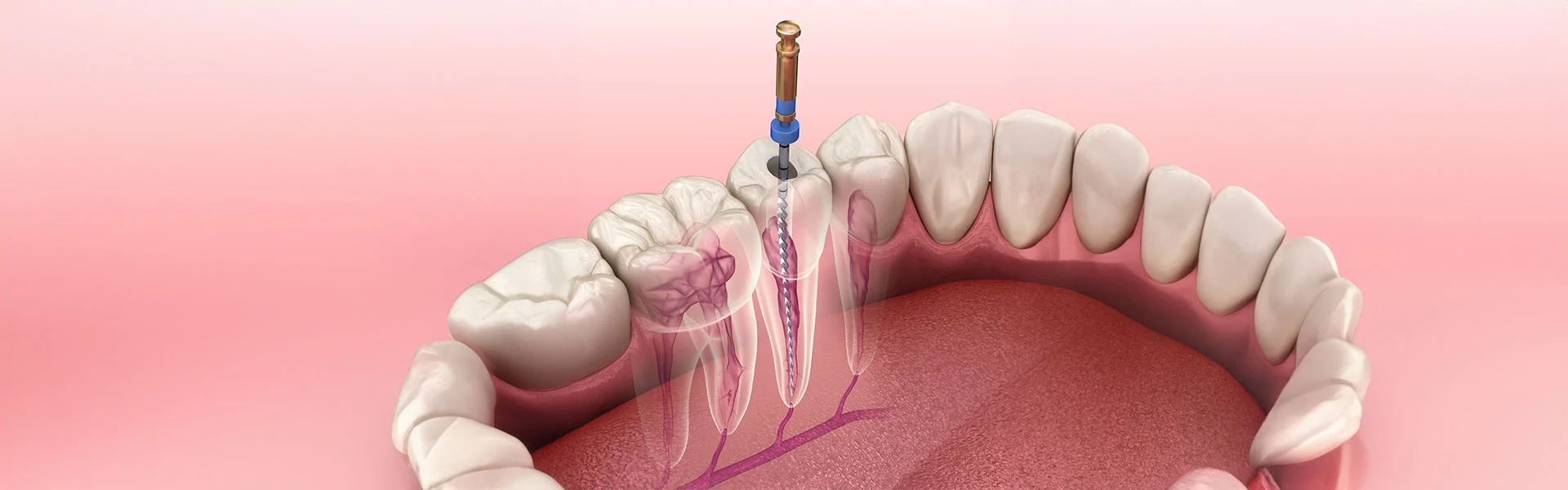 Root Canal Treatment