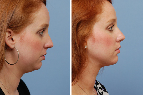 Chin Liposuction