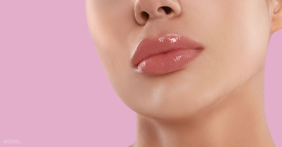 Lip flip (using botox)