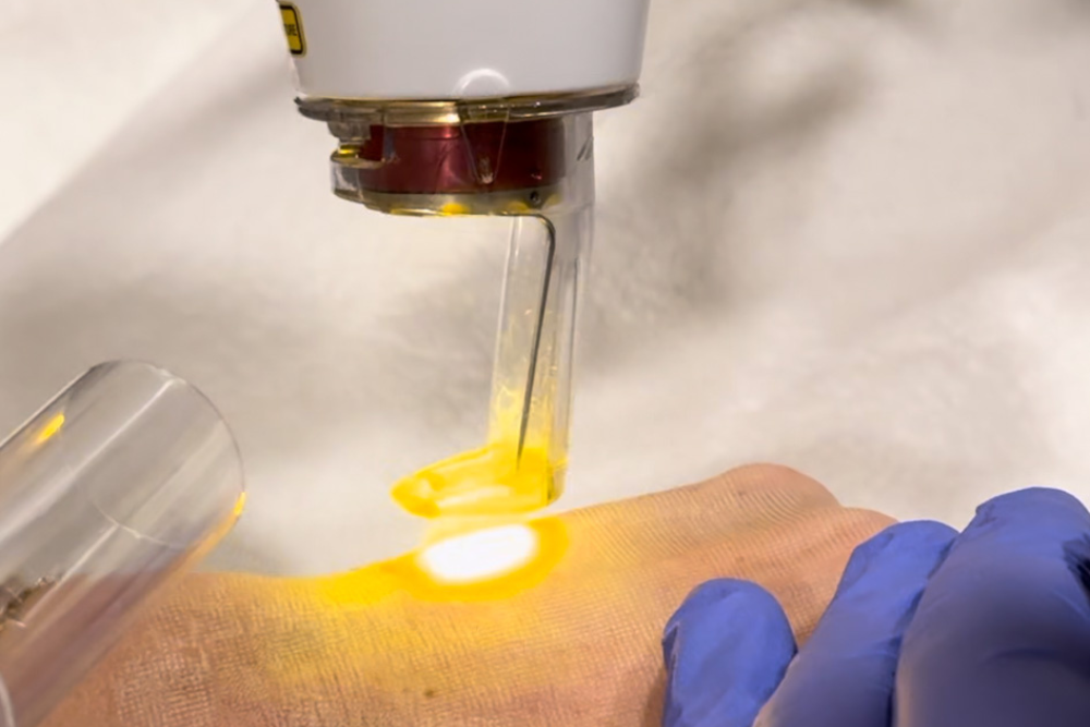 Ablative Fractional laser