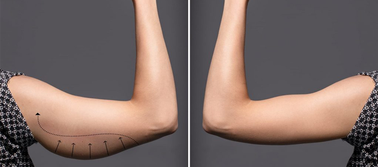 ARM AND THIGHS LIFTING