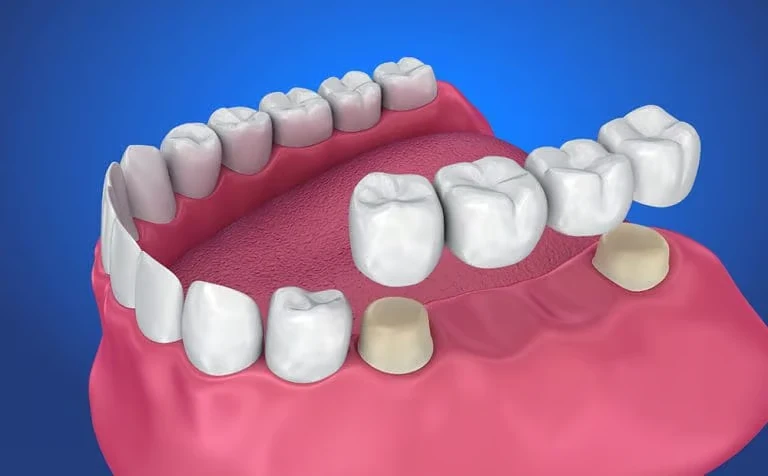 Crowns, Bridges, and Dentures
