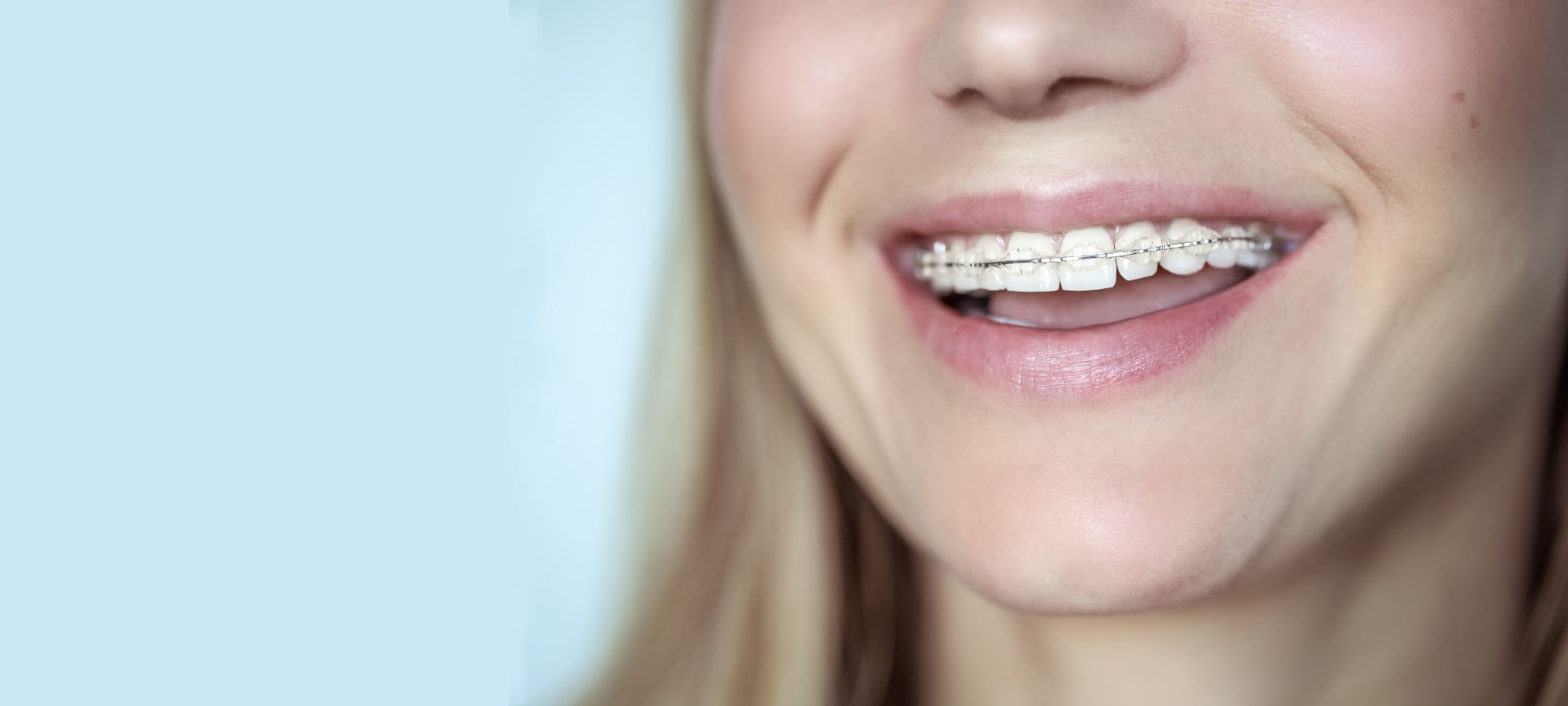 Ceramic braces placement