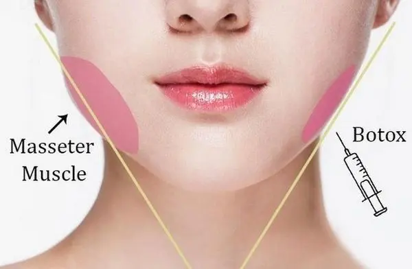 Masseter muscle reduction