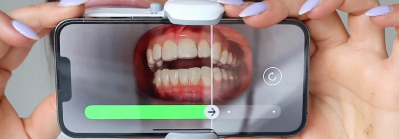 Monitoring tooth movement
