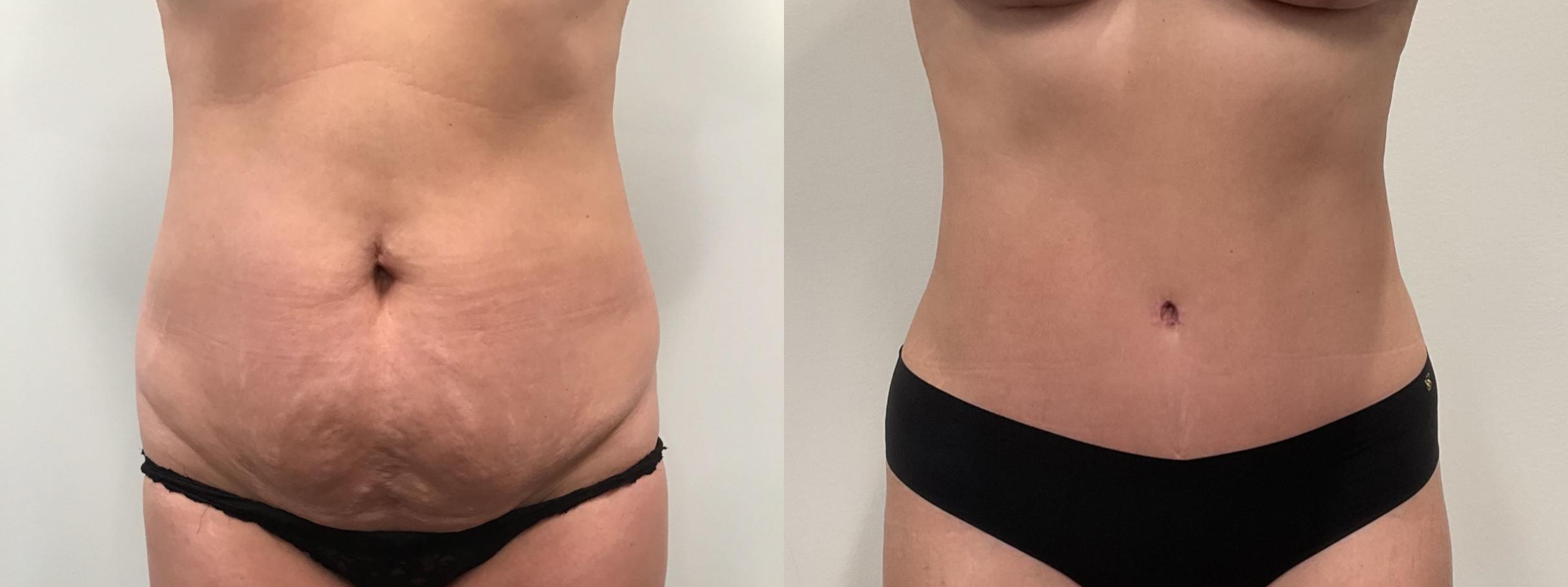 TUMMY TUCK