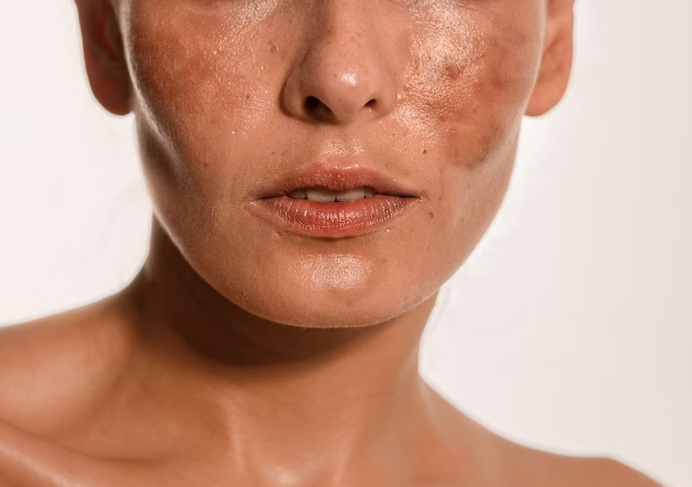 لماذا يزداد الكلف سوءاً في الصيف وكيف يمكن السيطرة عليه؟