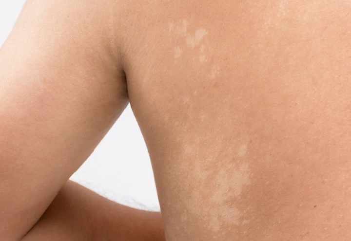 white spots on skin