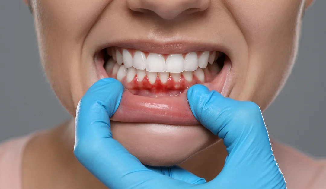 receding gums