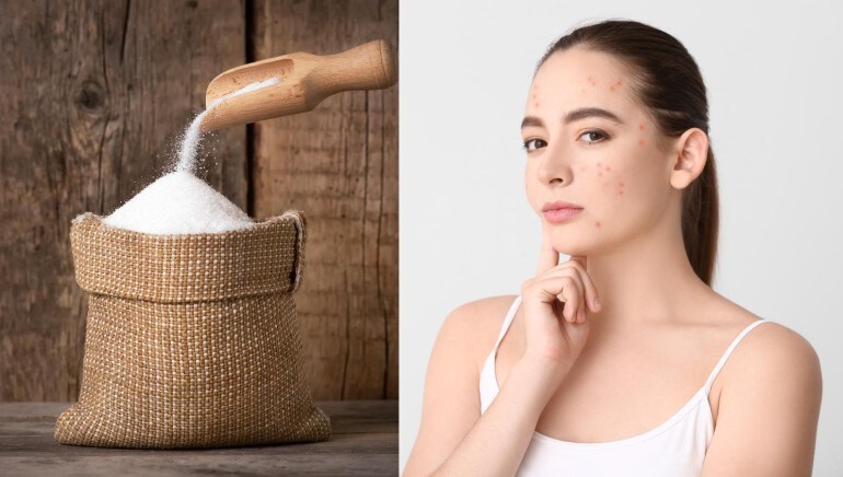 sugar skin
