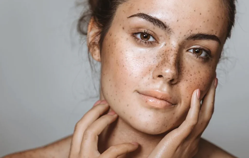 melasma