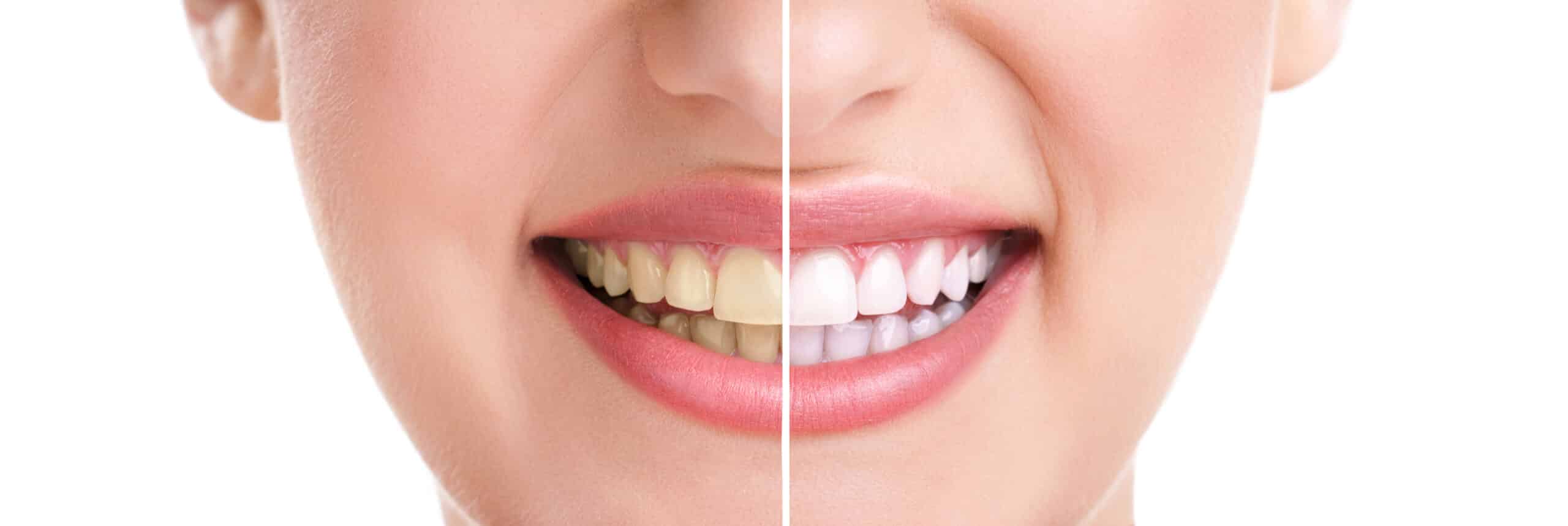 teeth colour