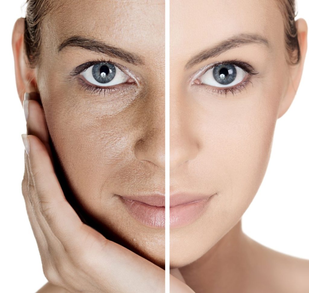 Hyaluronic Acid in Normal Skin